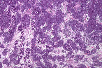 Стромальные типы опухолей яичников