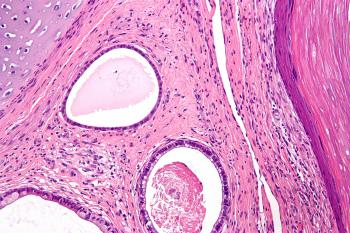 Виды опухолей яичников: тератома