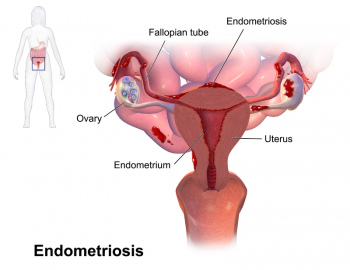Лечение эндометриоза