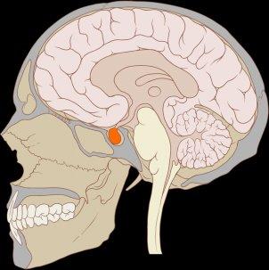 pituitary adenoma